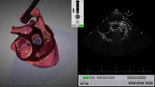 HeartWorks Mechanical Aortic Valve [upl. by Meehar]