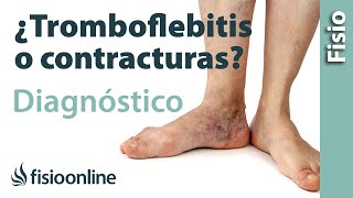 Cómo diferenciar una tromboflebitis de un dolor muscular de la pantorrilla o contractura muscular [upl. by Naitirb]