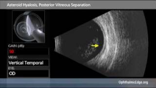 Asteroid Hyalosis Posterior Vitreous Separation [upl. by Kalagher289]