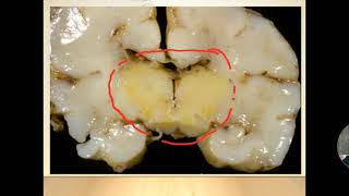 KERNICTERUS BILIRUBIN ENCEPHALOPATHY [upl. by Ymer132]