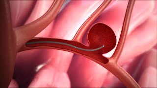 Endovascular Coiling of A Brain Aneurysm [upl. by Orlantha]