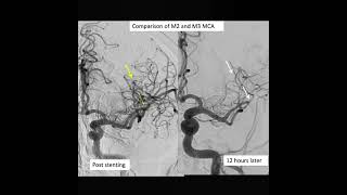 Left ICA stenosis following stenting developed aphasia [upl. by Annaeed217]