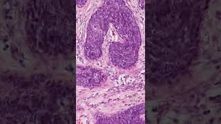 Nipple Adenoma Histology  Pathology shorts [upl. by Akselav]