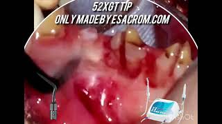 Embedded 305 premolar how to extract it easily in 10 seconds [upl. by Clute616]