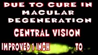 I CAN SEEE THE WHOLE WORLD I AM NOT BLIND NOW SAYS A PATIENT FROM AHMEDABAD POSSIBLE IN UJJAIN by [upl. by Malva]