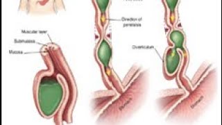 ESOPHAGEAL DIVERTICULA [upl. by Atiuqan532]