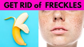 How to Get Rid of Freckles Naturally and Fast Overnight Permanently [upl. by Setiram]