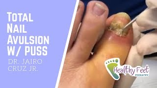 Total Nail Avulsion with Pus Infected Nail Fungal Nail w Abscess [upl. by Ymmij970]