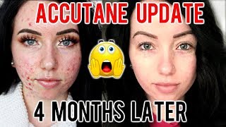 MY ACCUTANE JOURNEY 4 MONTH UPDATE Before amp After Progress Side Effects [upl. by Fadas643]