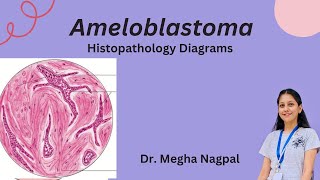 Ameloblastoma  Histopathology  Easiest Diagrams  Oral Pathology BDS [upl. by Fransen]