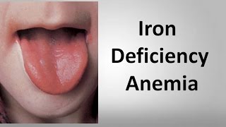 Iron Deficiency Anemia [upl. by Bloom779]