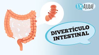 DOENÇA DIVERTICULAR E DIVERTICULITE SINTOMAS DIAGNÓSTICO E TRATAMENTO [upl. by Jerry]