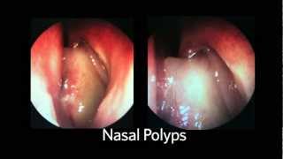 AAOHNSF The ENT Exam Episode 4 The Nasopharynx and Larynx Exam [upl. by Aicirtal]