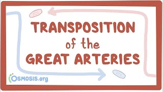 Transposition of the great arteries TGA  causes symptoms treatment amp pathology [upl. by Enilrad]