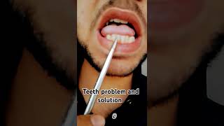 Teeth problem and solution teethsmile smiledental dentalclinic smile dentist smiledentist [upl. by Atoiyanap]