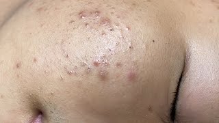 ACNE TREATMENT VU QUYNH MI  Perennial Blackheads On Boy Face 2024FULL [upl. by Bashemeth]