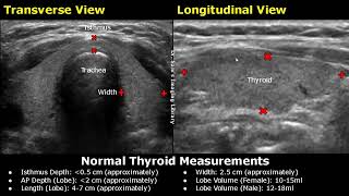 How To Measure Thyroid On Ultrasound  Length Width AP Depth amp Volume Measurements USG [upl. by Ardnuhsed]