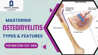 Mastering Osteomyelitis Types amp Features For NEETINICET MDS [upl. by Corbet]