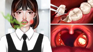 ASMR Dental Cleaning Procedures  Tonsil Stones Removal [upl. by Rebeka240]