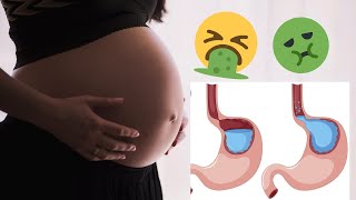 الحموضه و ارتجاع المرئ اثناء الحمل hyperacidity and GERD during pregnancy [upl. by Nike]