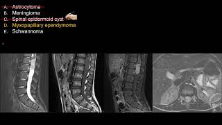 Neuroradiology Board Review  Spine Case 2 [upl. by Heuser45]