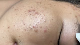 ACNE TREATMENT VU QUYNH MI  Blackheads Of Tweens 2024 EX [upl. by Tterrag890]