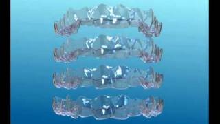 Information sur Invisalign [upl. by Oppen754]