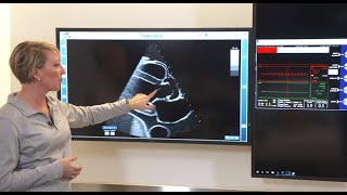 Managing Impella Position Using Imaging [upl. by Ardell643]