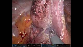 Robotic D J anastomosis for superior mesenteric artery syndrome [upl. by Susette103]