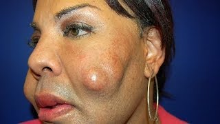 Cosmetic Surgery Disaster Woman Dubbed Cement Face Given New Lease Of Life [upl. by Aicilic744]