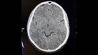 Encephalitis and subarachnoid hemorrhages in a case of Aplastic anaemia [upl. by Eidissac574]