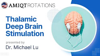 Michael Lu Thalamic Deep Brain Stimulation for Closed Head injury [upl. by Mercer]