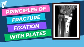 Principles of Fracture Internal Fixation With Plates and Screws  Material Properties [upl. by Hermina478]