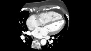 Atrial Septal Defect [upl. by Collen]