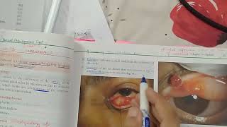 Chalazion  EYELIDS Lecture 1  Jatoi [upl. by Tray395]