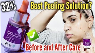 Derma co 30 AHA 2 BHA Peeling Solution Review  Best Peeling Solution How to Use Chemical Peel [upl. by Leahcimrej624]