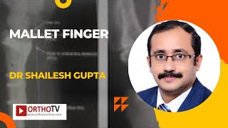 Mallet Finger by Dr Shailesh Gupta [upl. by Gnouhp]