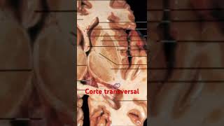 🧠¡Núcleos basales en cerebro real Video completo ⬆️⬆️ anatomia anatomiafacil anatomiapratica [upl. by Anitaf161]