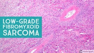 LowGrade Fibromyxoid Sarcoma Evans Tumor 101Explained by a Sarcoma Pathologist [upl. by Tryck]