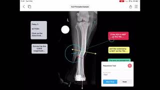 What are the principles of angular limb deformity correction An explanation in vPOPpro [upl. by Name]