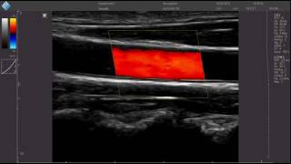 Carotide CFMmp4 [upl. by Lazaro]