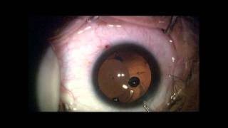 DSAEK quotTriplequot Procedure at Duke Eye Center by Alan N Carlson MD [upl. by Tjaden]