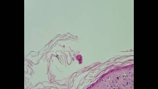 Histopathology of Lupus erythematosus [upl. by Brett]