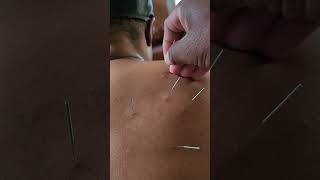 acupuncture needle needling upper back pain shortness of breath creating anxiety [upl. by Kleper3]