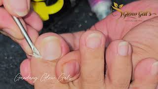 Ingrown Toenail Removal [upl. by Kacerek]