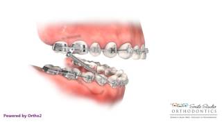 Forsus  Orthodontic Appliance [upl. by Ahseuqal]