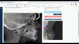 Introducción al software WebCeph  Análisis cefalométrico en pocos minutos [upl. by Altis603]