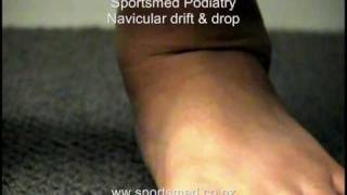 Sportsmed podiatry  Navicular drift and drop [upl. by Ronym]