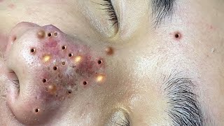 Big Cystic Acne Blackheads Extraction Blackheads amp Milia Whiteheads Removal Pimple Popping  9038 [upl. by Atem585]