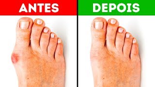 5 Dicas Para Aliviar A Dor No Joanete [upl. by Deys]